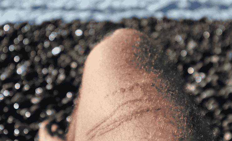 Puntura di medusa