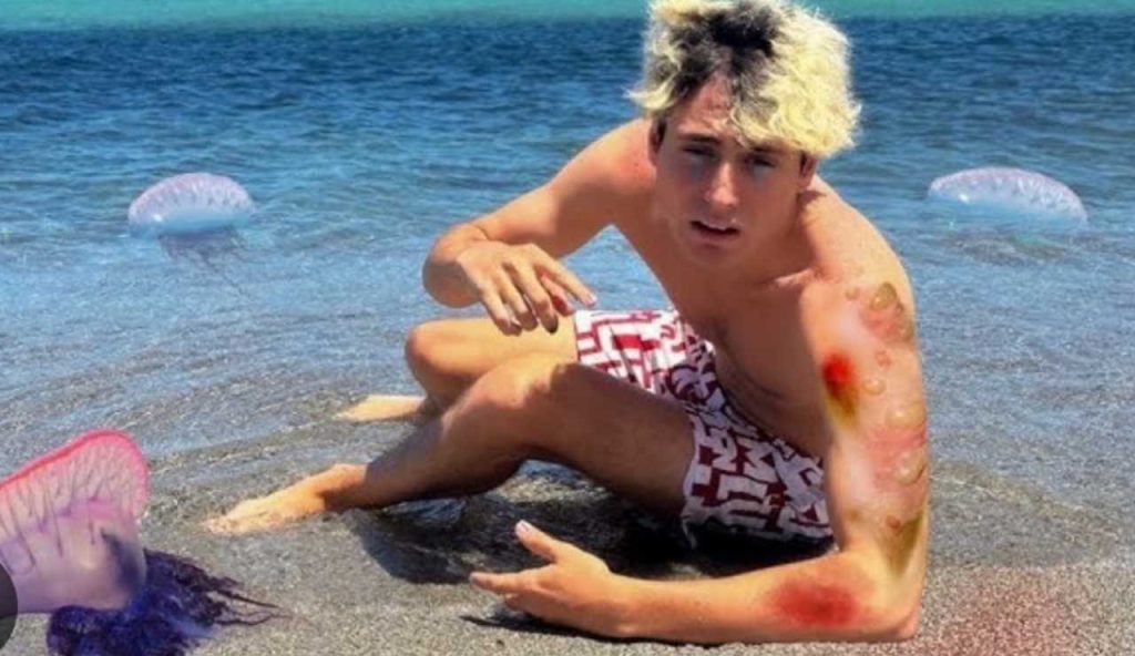 Ragazzo punto da una medusa